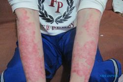 PSORIASIS: Perokok Berisiko Tinggi Psoriasis   