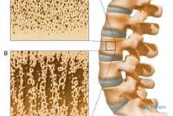 PENYAKIT TULANG: Waspadai Osteoporosis Karena Faktor Sekunder