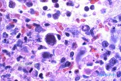 DIEGO MENDIETA MENINGGAL DUNIA: Apa itu Virus Cytomegalo