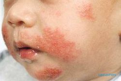 TIPS KESEHATAN : Bagaimana Cara Mendeteksi Alergi pada Anak?