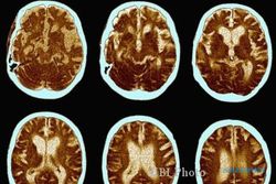 INFO MEDIS : Peneliti AS Temukan Cara Deteksi Dini Alzheimer