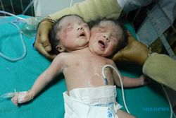 KISAH UNIK : Wanita India Lahirkan Bayi Berkepala 2