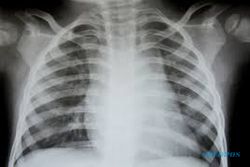 TUBERCOLUSIS WONOGIRI : Penderita TB-MDR Meningkat, DKK Wonogiri Ingatkan Dukungan Keluarga Penting