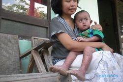 BOCAH KULIT BERSISIK : Tak Punya Biaya Berobat, Bayi Malang Itu Hanya Dirawat di Rumah
