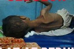 GIZI BURUK : Astaga, Tubuh Bocah Asal Magetan Ini Kurus Kering Gara-Gara Kelaparan