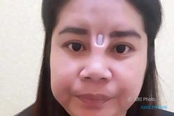 KISAH TRAGIS : Operasi Hidung Murahan, Wanita Ini Alami Hal Mengerikan
