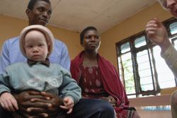 Orang Albino di Afrika: Diburu demi Kekuatan Magis