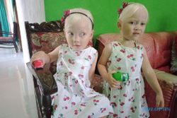 Masuk Kategori Albino Tingkat Tinggi, Anak Kembar Wonogiri Punya Kulit Putih Tanpa Bintik