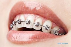 Begini Cara Perawatan Gigi yang Dipasangi Behel