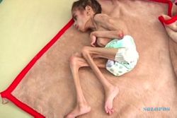 Cerebral Palsy & Kelaparan, Berat Badan Bocah Ini Cuma 7 Kg