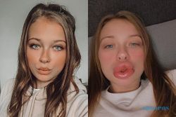 Tergiur Iklan Filer di Facebook, Bibir Wanita Ini Berubah Jadi Mengerikan