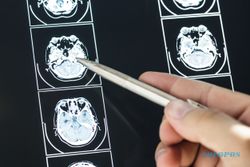 Mengenal Apa Itu Mati Batang Otak yang Dialami Bocah Bekasi Setelah Operasi