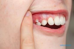 Kenali Ciri-Ciri Gigi Gingsul pada Anak Sebelum Terlambat